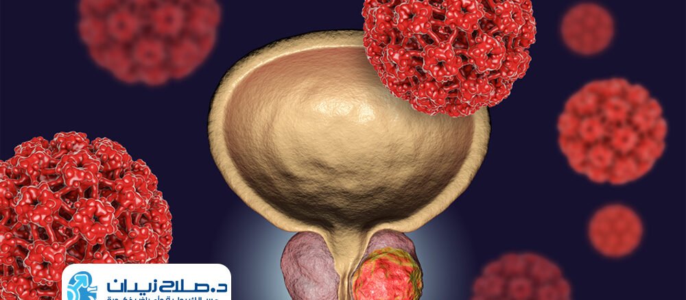 استئصال ورم المثانة بالمنظار