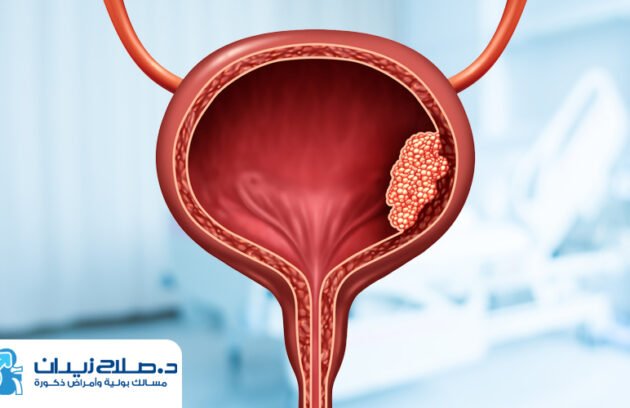 اعراض سرطان المثانة