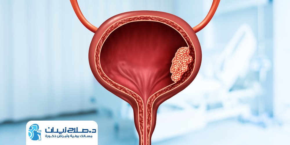 اعراض سرطان المثانة