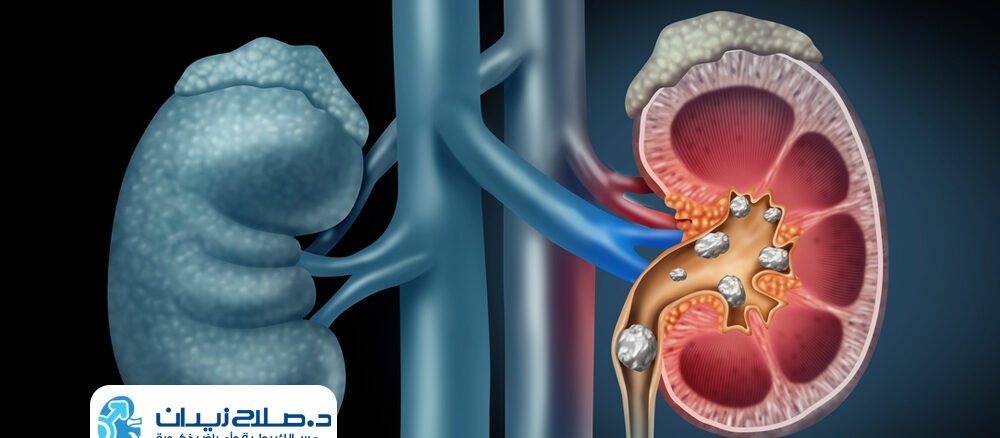 تفتيت حصى الكلى بالليزر