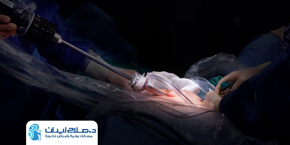 تكلفة عملية استئصال البروستاتا