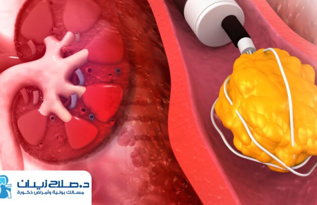 تكلفة عملية تفتيت حصى الكلى بالمنظار