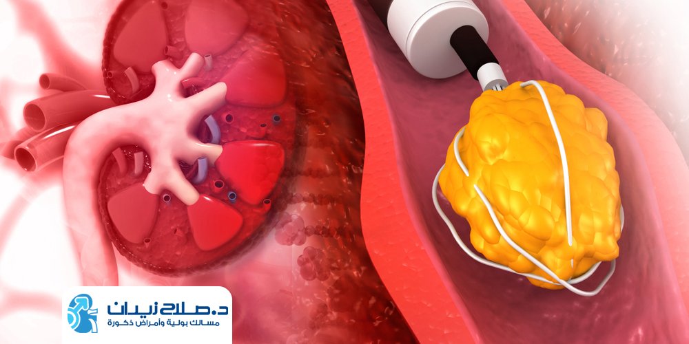 تكلفة عملية تفتيت حصى الكلى بالمنظار