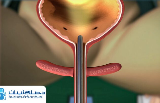 تكلفة منظار المثانة