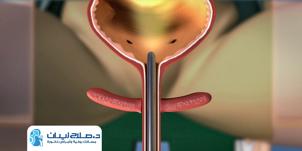 تكلفة منظار المثانة