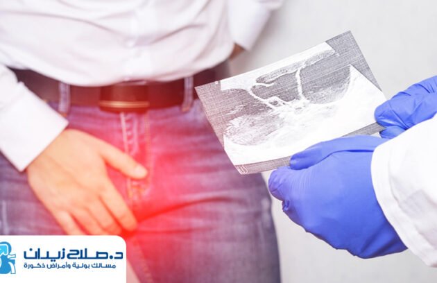 سعر عملية دوالي الخصية