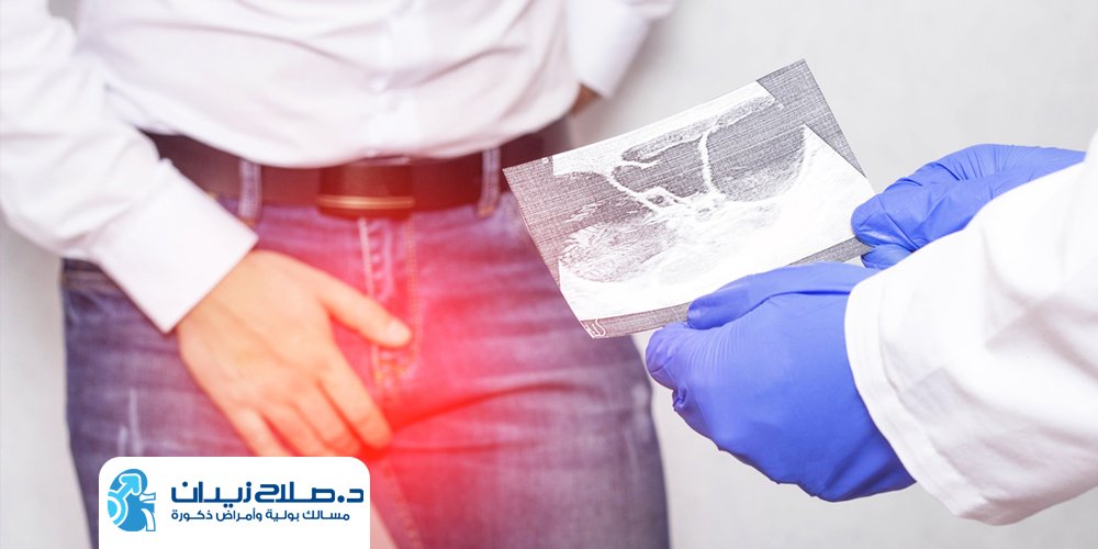 سعر عملية دوالي الخصية