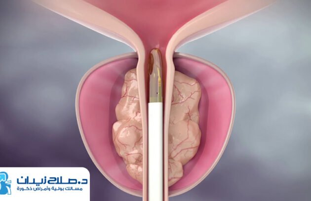 عملية البروستاتا بالتبخير