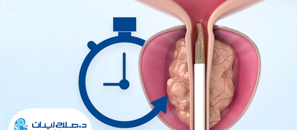 مدة عملية البروستاتا بالتبخير