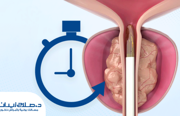 مدة عملية البروستاتا بالتبخير