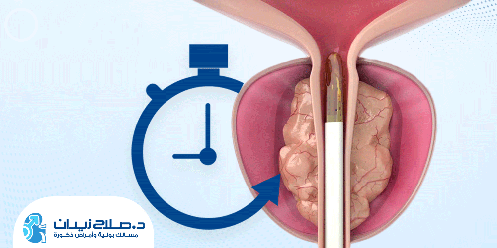 مدة عملية البروستاتا بالتبخير