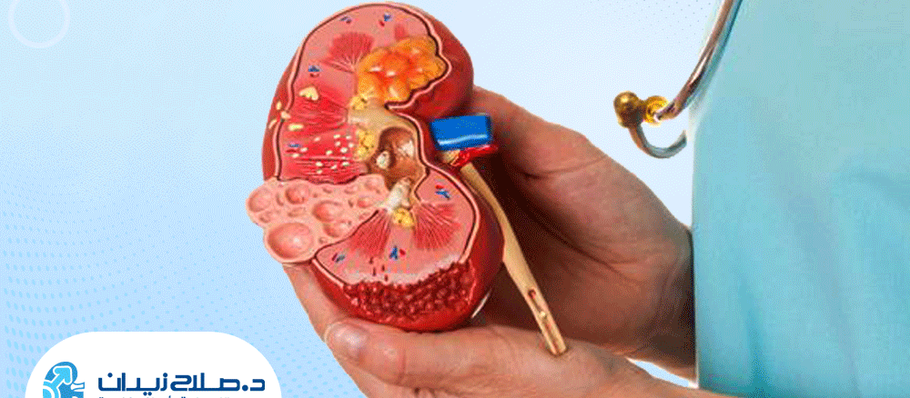 تجربتي مع تفتيت الحصى بالليزر
