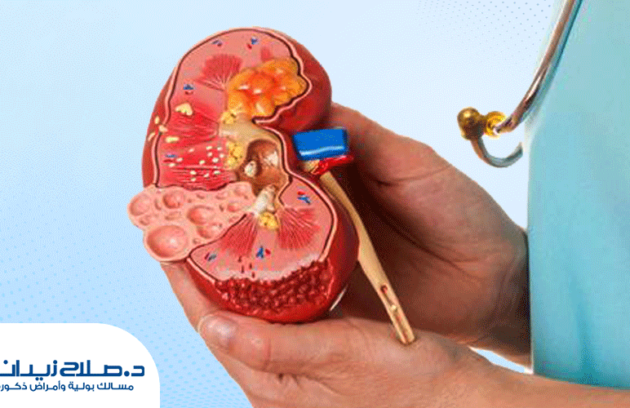 تجربتي مع تفتيت الحصى بالليزر