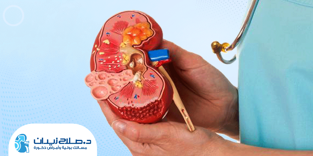 تجربتي مع تفتيت الحصى بالليزر