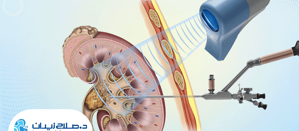 علاج الحصوات بالمنظار المرن والليزر