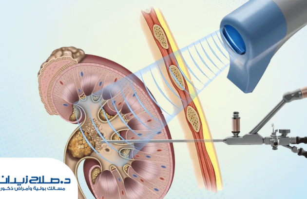علاج الحصوات بالمنظار المرن والليزر