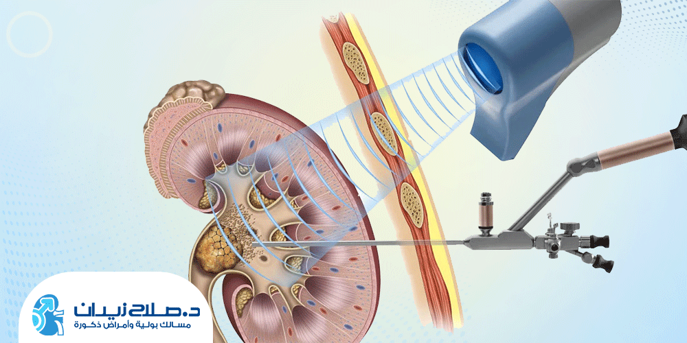 علاج الحصوات بالمنظار المرن والليزر