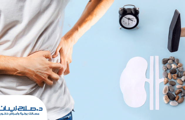 علامات-نزول-حصوة-الكلى