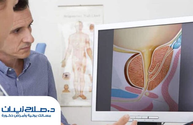علاج البروستاتا بالرزيوم في مصر