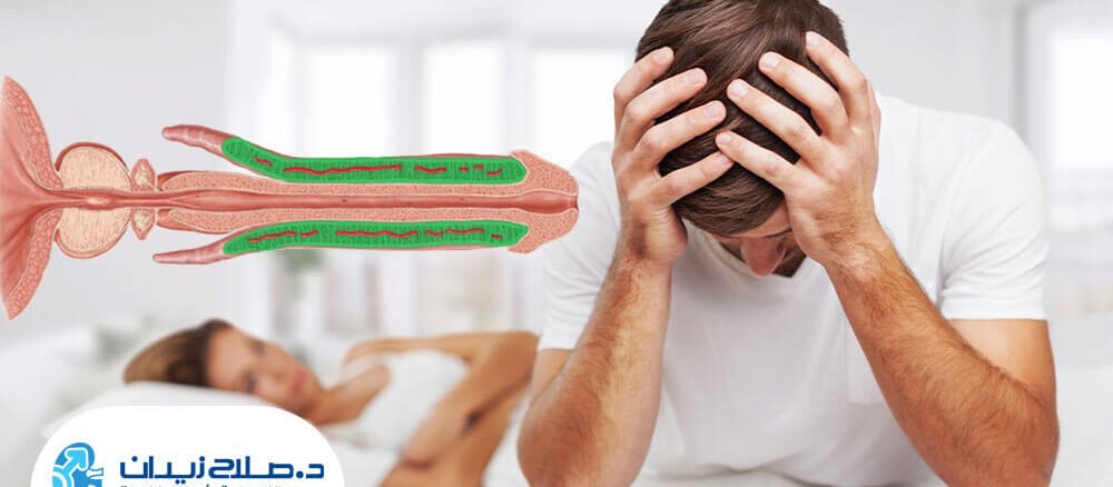 كيف-يتم-تركيب-الدعامة-للذكر؟