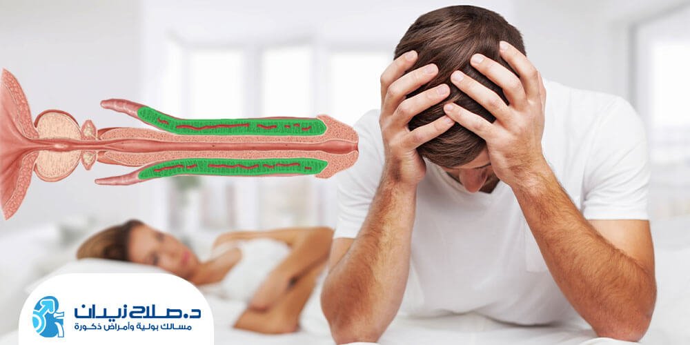 كيف-يتم-تركيب-الدعامة-للذكر؟