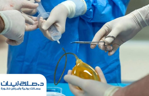 نصائح بعد عملية زرع دعامة العضو الذكري