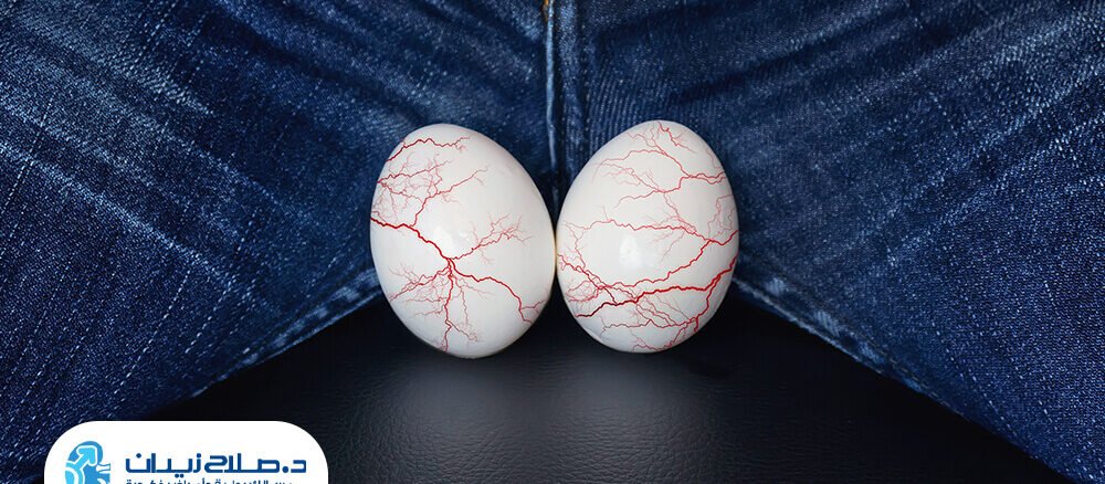 هل دوالي الخصية تسبب تأخر الإنجاب؟