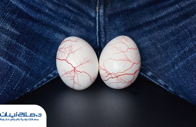 هل دوالي الخصية تسبب تأخر الإنجاب؟