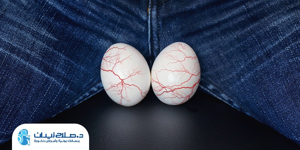 هل دوالي الخصية تسبب تأخر الإنجاب؟