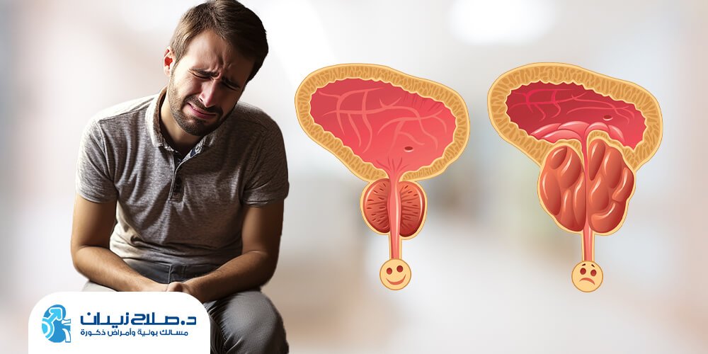 هل يعود تضخم البروستاتا بعد استئصالها؟